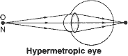 In a hypermetropic eye, the image of nearby object lying at normal near point N