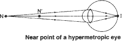 The near point N of hypermetropic eye is farther away from the normal near point N